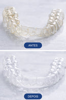 Antes e Depois de alinhador usar Espuma Clareadora