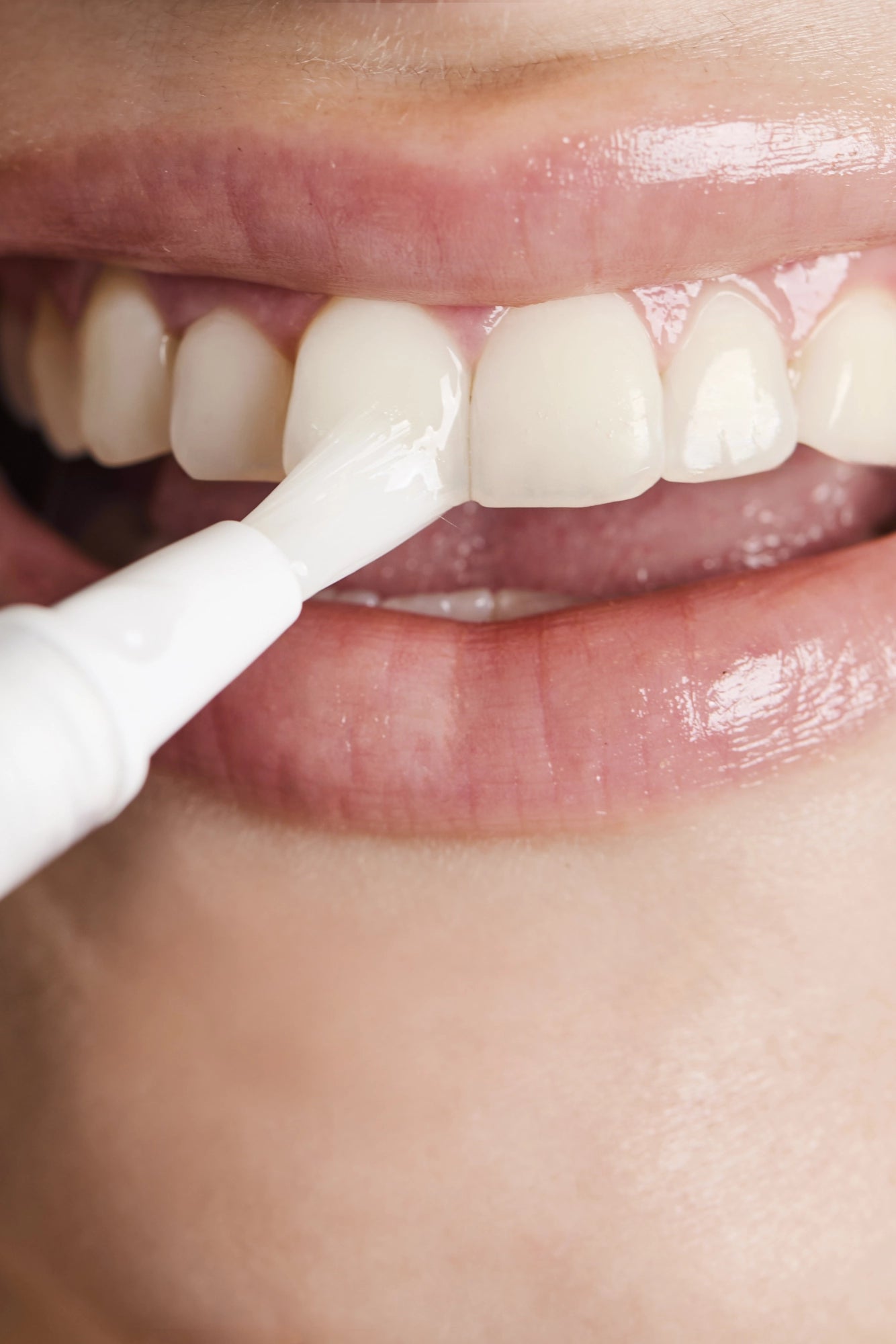 Caneta clareadora sendo aplicada em dentes